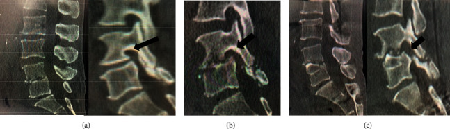 The Limitation of Endoscopic Surgery Using the Full Endoscopic Discectomy System for the Treatment of Destructive Stage Pyogenic Spondylodiscitis: A Case Series.