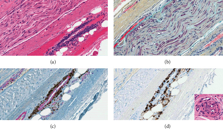 Vasculitic Tibial Mononeuropathy Associated with Inherited Immune Dysregulation: A Review of Tibial Mononeuropathies with Electrodiagnostic Considerations.
