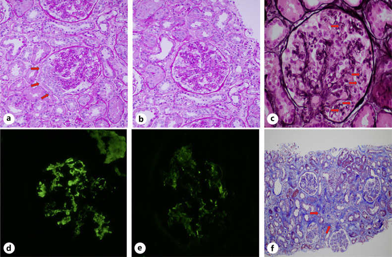 IgA Nephropathy Secondary to Ipilimumab Use.