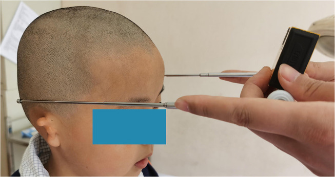 Utility of a Ruler for Reconstructed Auricle Positioning.