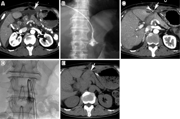 Fibrin Glue in Interventional Radiology: How to Use It.