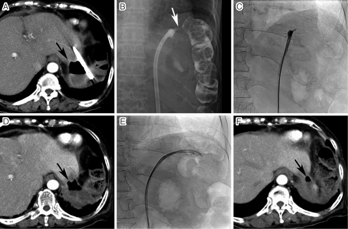 Fibrin Glue in Interventional Radiology: How to Use It.