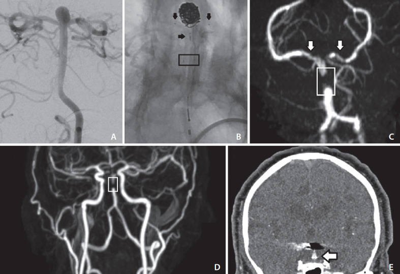 PulseRider Treated Aneurysm with Significant Artifact on Postoperative Magnetic Resonance Angiography: A Case Report and Literature Review.