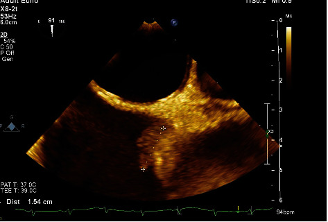 A Conservative Approach to a Large Mycotic Pulmonary Pseudoaneurysm.