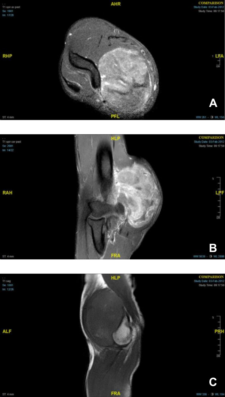 Monophasic Synovial Sarcoma in the Elbow Misclassified but Successfully Treated as Ewing's Sarcoma with Chemotherapy.