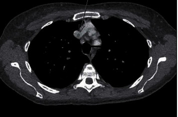 A Conservative Approach to a Large Mycotic Pulmonary Pseudoaneurysm.