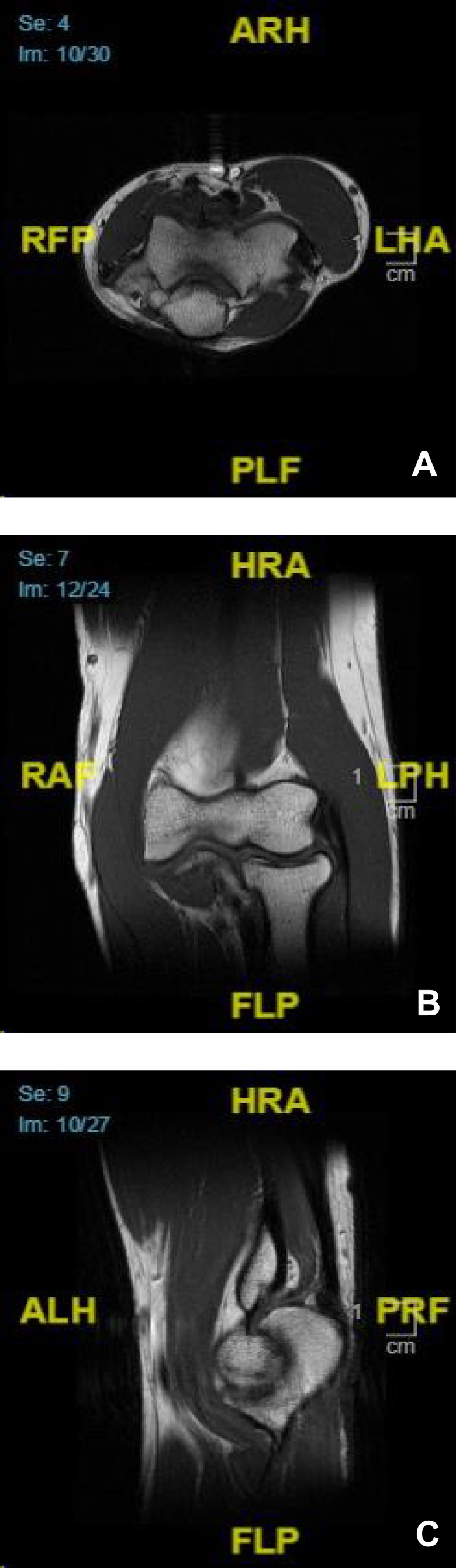 Monophasic Synovial Sarcoma in the Elbow Misclassified but Successfully Treated as Ewing's Sarcoma with Chemotherapy.