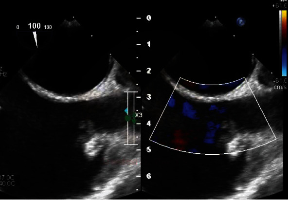 A Conservative Approach to a Large Mycotic Pulmonary Pseudoaneurysm.