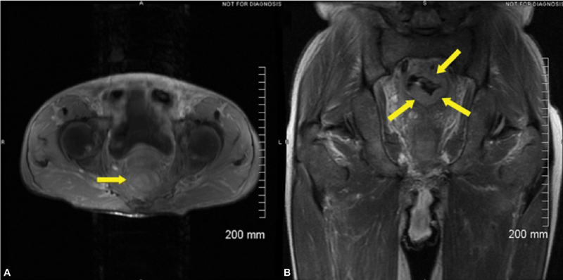 Large Bowel Obstruction Caused by Metastatic Prostate Cancer: A Case Report.