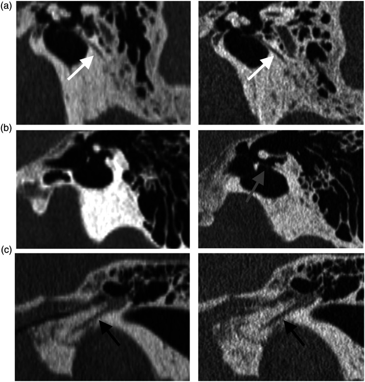 Improved visualization of the chorda tympani nerve using ultra-high-resolution computed tomography.