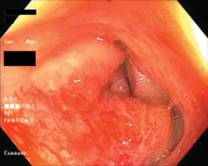 Large Bowel Obstruction Caused by Metastatic Prostate Cancer: A Case Report.