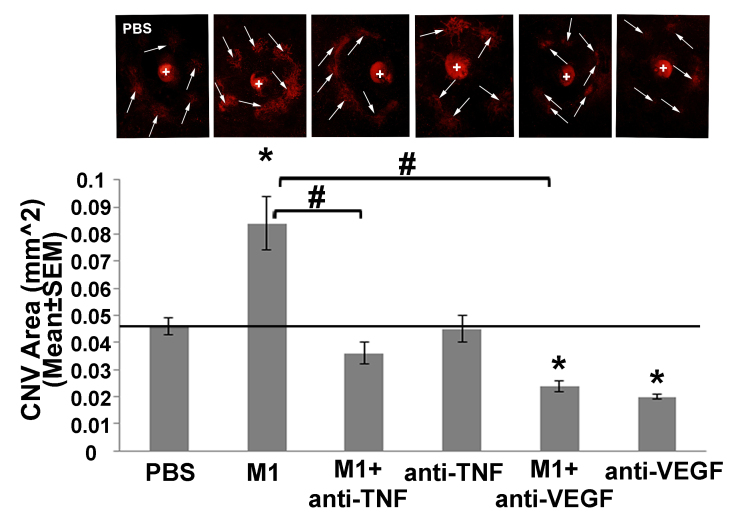 Anti-tumor necrosis factor alpha reduces the proangiogenic effects of activated macrophages derived from patients with age-related macular degeneration.