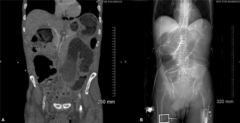 Large Bowel Obstruction Caused by Metastatic Prostate Cancer: A Case Report.