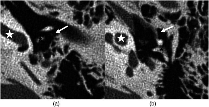 Improved visualization of the chorda tympani nerve using ultra-high-resolution computed tomography.