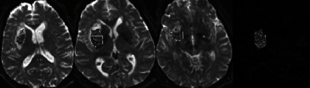 From Spot Sign to Bleeding on the Spot: Classic and Original Signs of Expanding Primary Spontaneous Intracerebral Hematoma.