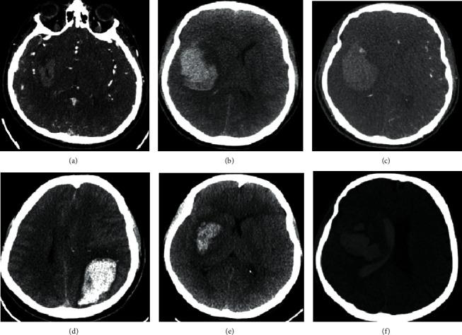 From Spot Sign to Bleeding on the Spot: Classic and Original Signs of Expanding Primary Spontaneous Intracerebral Hematoma.