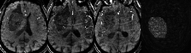 From Spot Sign to Bleeding on the Spot: Classic and Original Signs of Expanding Primary Spontaneous Intracerebral Hematoma.