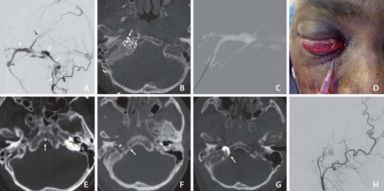 Direct Superior Ophthalmic Vein Approach to Treat Anterior Condylar Confluence Dural Arteriovenous Fistula.