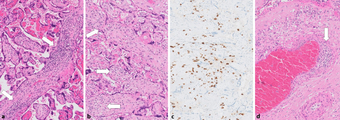 [Impact of SARS-CoV-2/COVID-19 on the placenta].