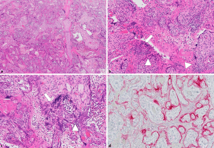 [Impact of SARS-CoV-2/COVID-19 on the placenta].