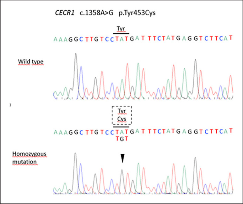 A Case of Deficiency of Adenosine Deaminase 2: 28 years of Diagnostic Challenges.