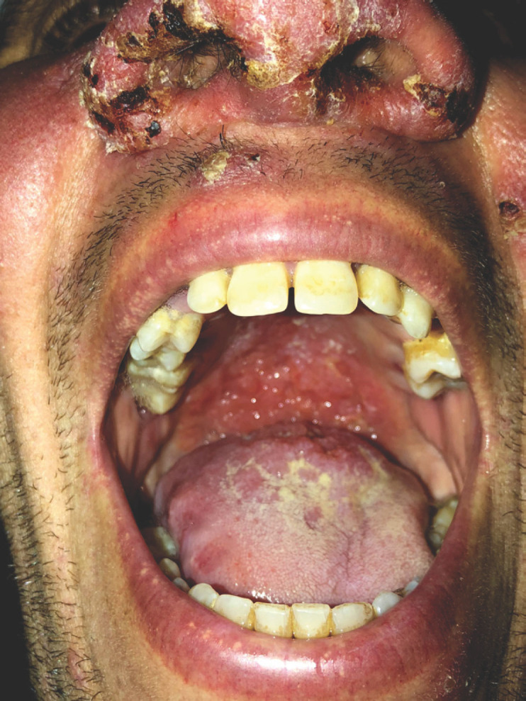 [Generalized old world leishmaniasis: first Moroccan case in an immunocompetent adult?]