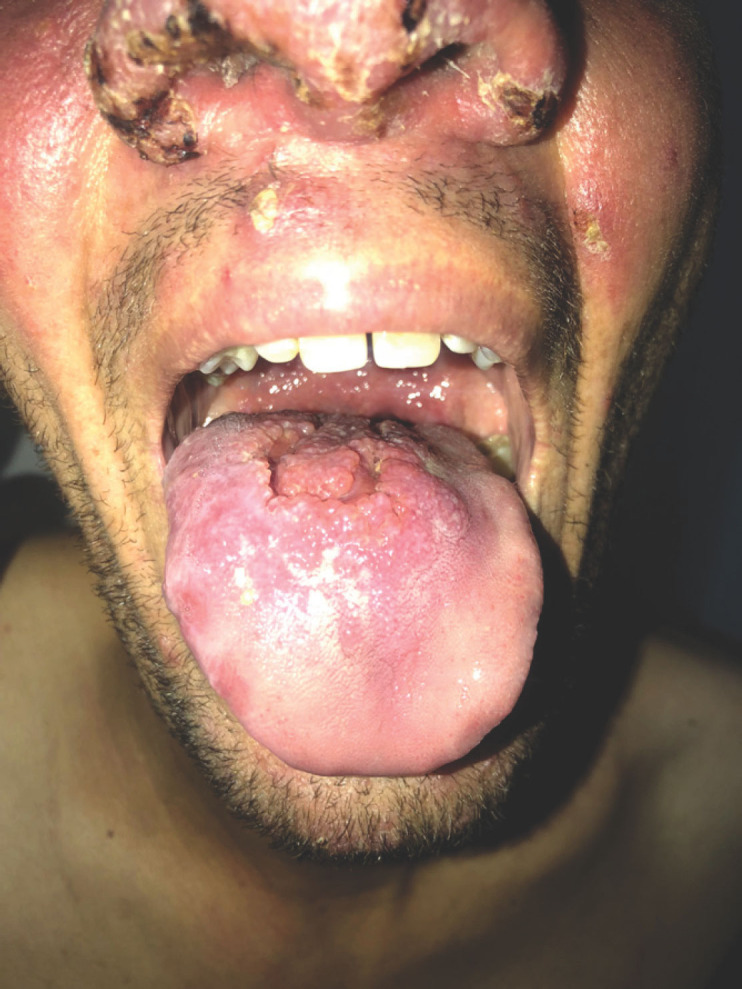 [Generalized old world leishmaniasis: first Moroccan case in an immunocompetent adult?]