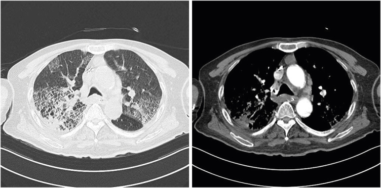 Hemoptysis in Quadriplegia with Atrial Fibrillation Who Was Taking Edoxaban: a Case Report.