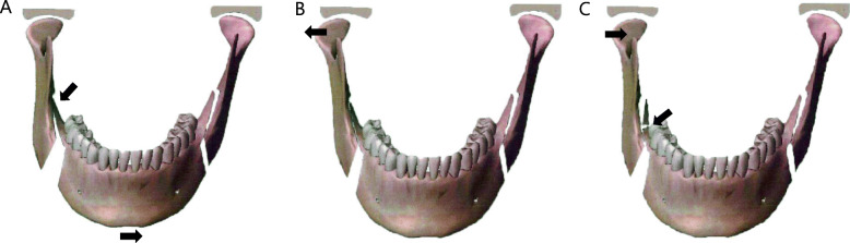 Is distal segment ostectomy essential for stabilization of the condylar position in patients with facial asymmetry?