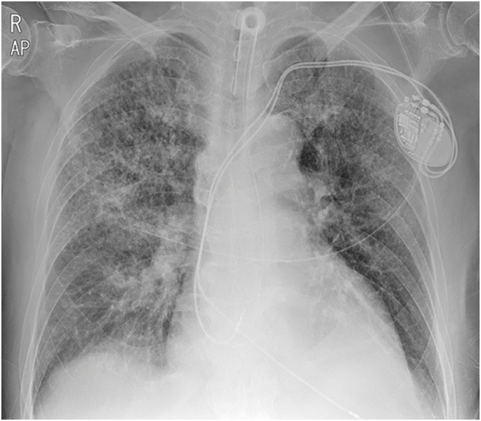 Hemoptysis in Quadriplegia with Atrial Fibrillation Who Was Taking Edoxaban: a Case Report.