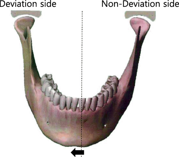 Is distal segment ostectomy essential for stabilization of the condylar position in patients with facial asymmetry?