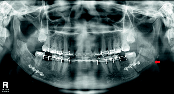 Is distal segment ostectomy essential for stabilization of the condylar position in patients with facial asymmetry?