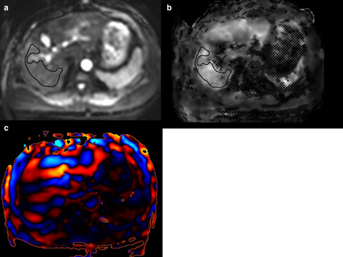 A proposed model on MR elastography for predicting postoperative major complications in patients with hepatocellular carcinoma.