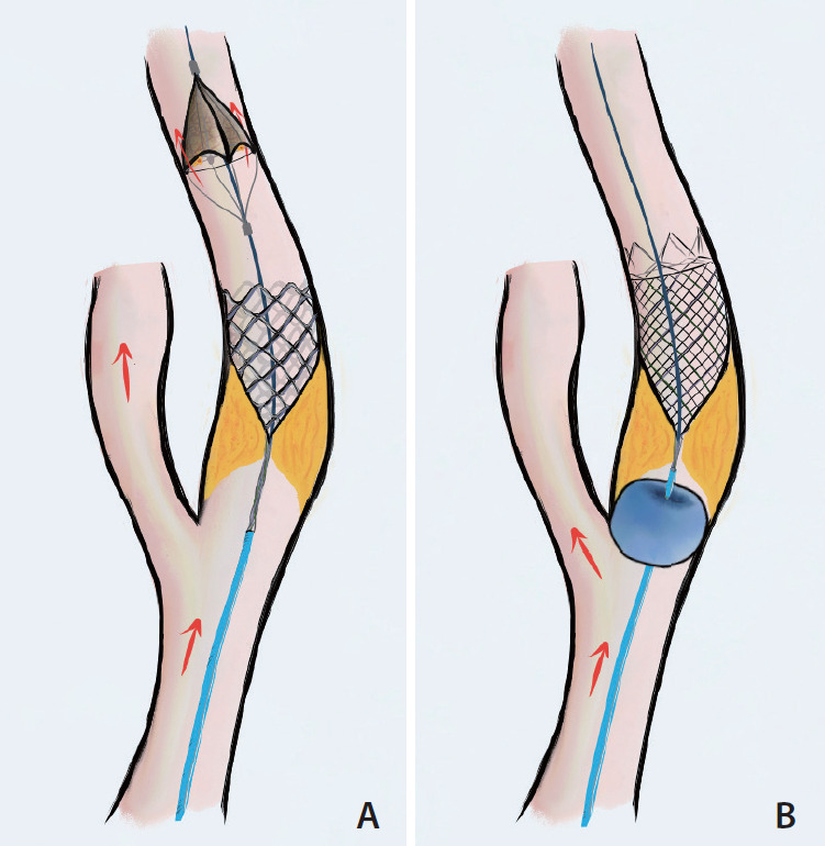 CaRotid Artery Filtering Technique (CRAFT): A Technique for Carotid Artery Stenting with Intrinsic Embolic Protection.