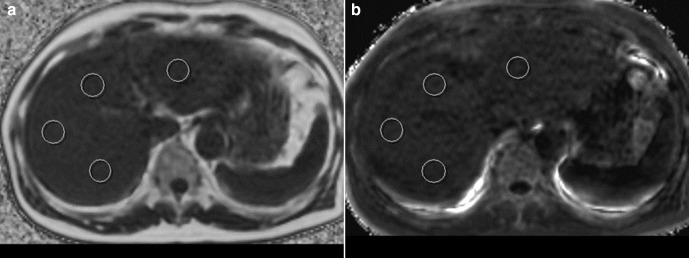 A proposed model on MR elastography for predicting postoperative major complications in patients with hepatocellular carcinoma.