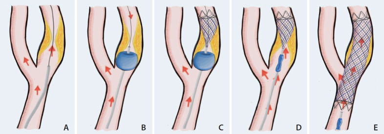 CaRotid Artery Filtering Technique (CRAFT): A Technique for Carotid Artery Stenting with Intrinsic Embolic Protection.