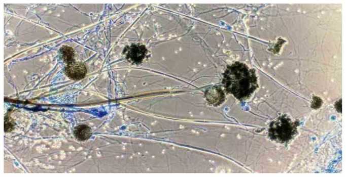 Awareness Toward Mucormycosis Attack for COVID Patients.