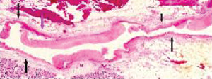 Segmental Arterial Mediolysis: A Multiguised Vasospastic Arteriopathy with Collateral Mesangial Cell Hyperplasia and Cardiac Toxicity Generated by Norepinephrine and Hyperdense Adrenoceptors Alone or by Crosstalk with Other Pressor Agents.