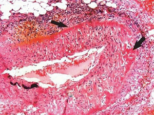 Segmental Arterial Mediolysis: A Multiguised Vasospastic Arteriopathy with Collateral Mesangial Cell Hyperplasia and Cardiac Toxicity Generated by Norepinephrine and Hyperdense Adrenoceptors Alone or by Crosstalk with Other Pressor Agents.