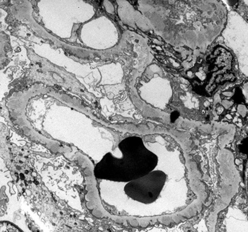 Malignancy-Associated Membranous Nephropathy with Positive Anti-PLA2R Autoantibodies: Coincidence or Connection.