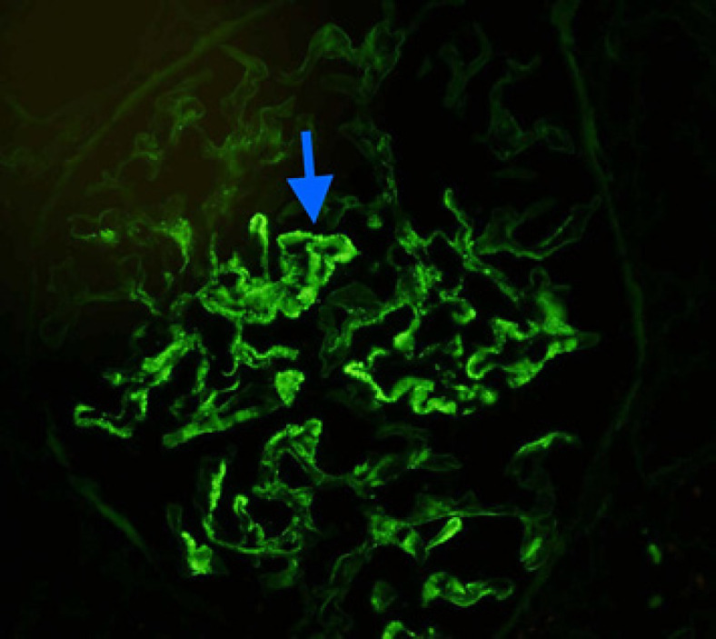 Malignancy-Associated Membranous Nephropathy with Positive Anti-PLA2R Autoantibodies: Coincidence or Connection.