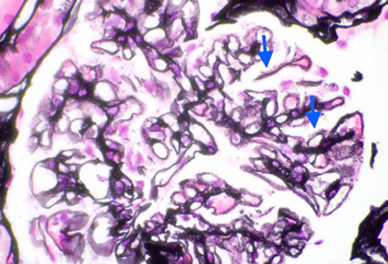 Malignancy-Associated Membranous Nephropathy with Positive Anti-PLA2R Autoantibodies: Coincidence or Connection.