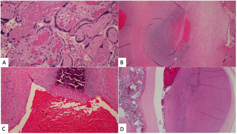 Examining the Relationship Between Gastroschisis and Placental Fetal Vascular Malperfusion.