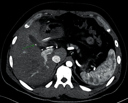 Cystic Artery Pseudoaneurysm: Current Review of Aetiology, Presentation, and Management.
