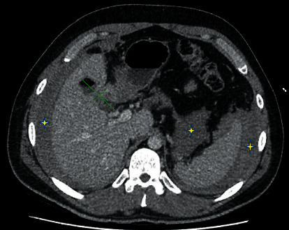 Cystic Artery Pseudoaneurysm: Current Review of Aetiology, Presentation, and Management.