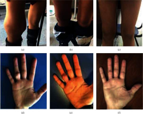 From the Old, the Best: Parathyroidectomy in the Management of Soft-Tissue and Vascular Calcification in Patients with Chronic Renal Disease.