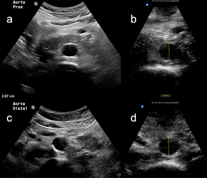 Abdominal aorta measurements by a handheld ultrasound device compared with a conventional cart-based ultrasound machine.