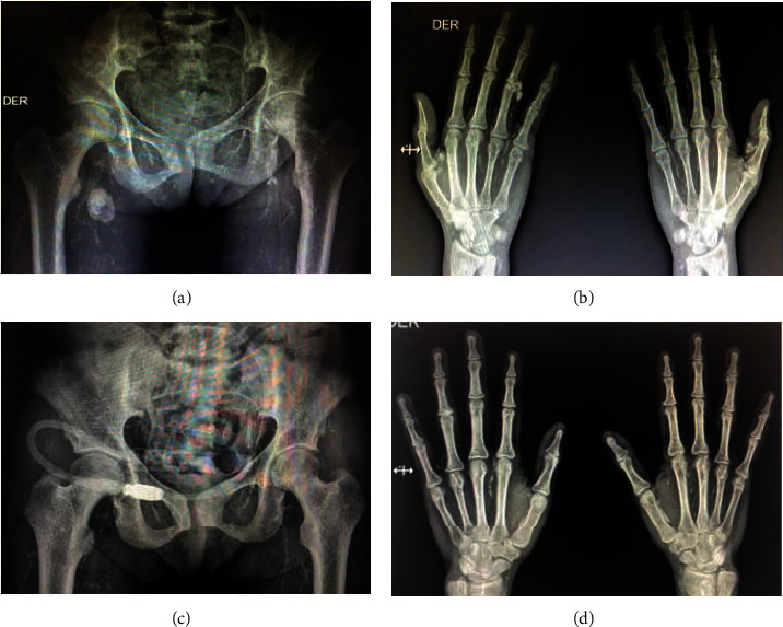 From the Old, the Best: Parathyroidectomy in the Management of Soft-Tissue and Vascular Calcification in Patients with Chronic Renal Disease.