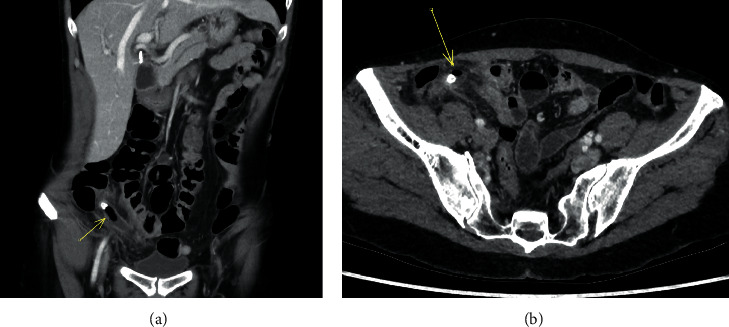 Appendiceal Intraluminal Gas: A CT Marker for Gangrenous Appendicitis.