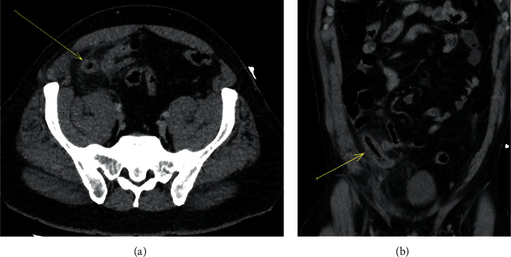 Appendiceal Intraluminal Gas: A CT Marker for Gangrenous Appendicitis.